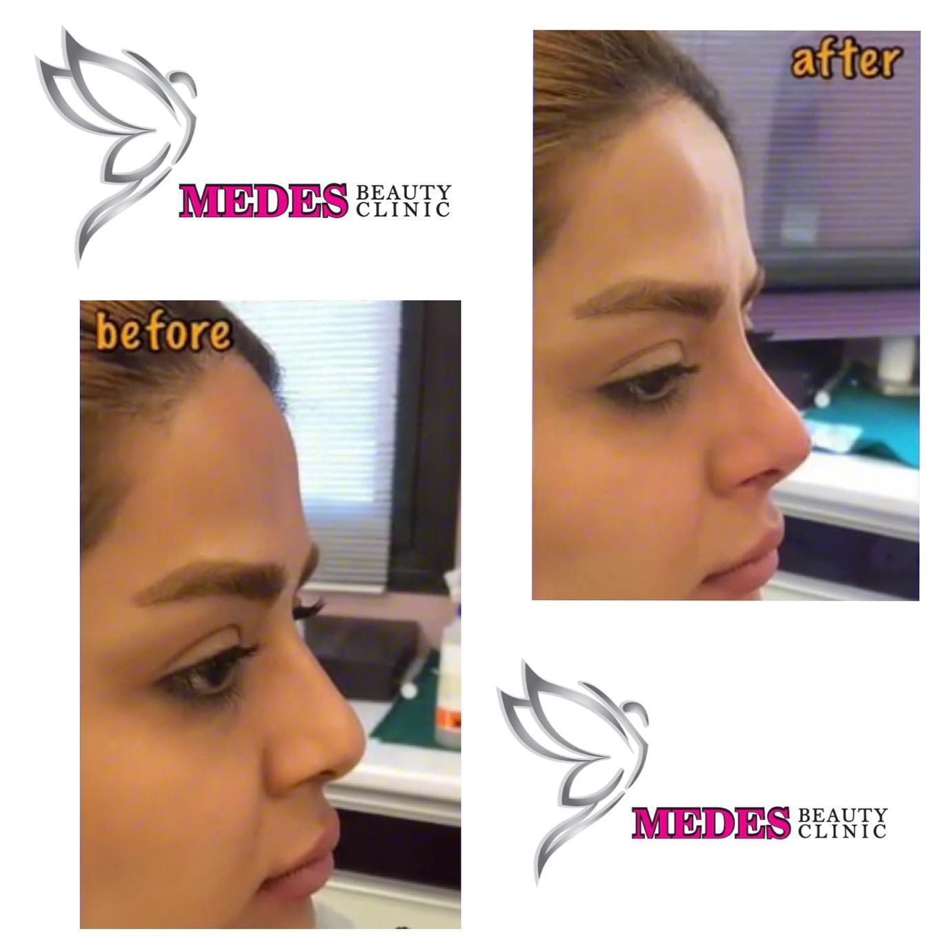 گالری لیفت با نخ